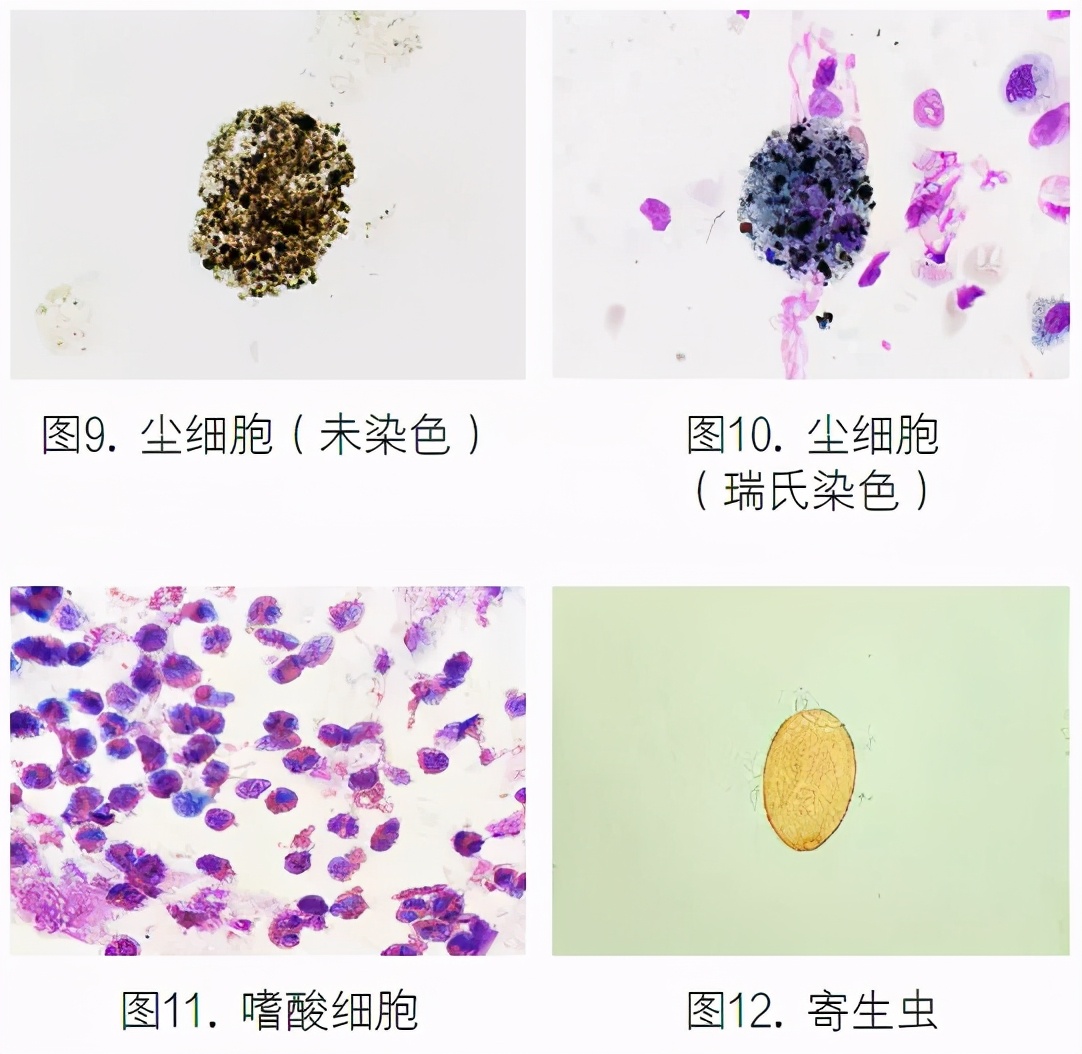 支气管肺泡灌洗液检测技术规范,肺泡灌洗液肿瘤细胞检查准确性