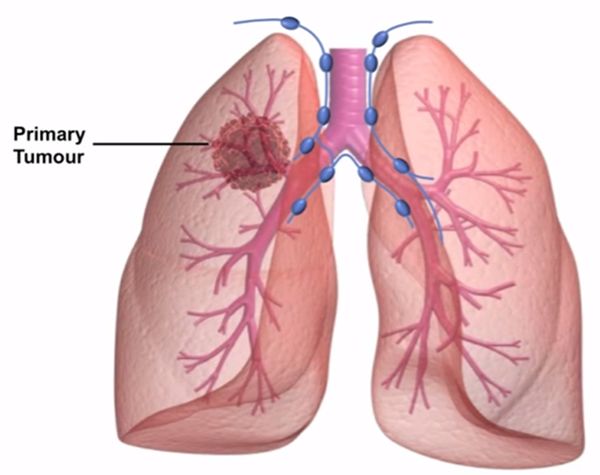 抗癌疫苗的研发,抗癌疫苗