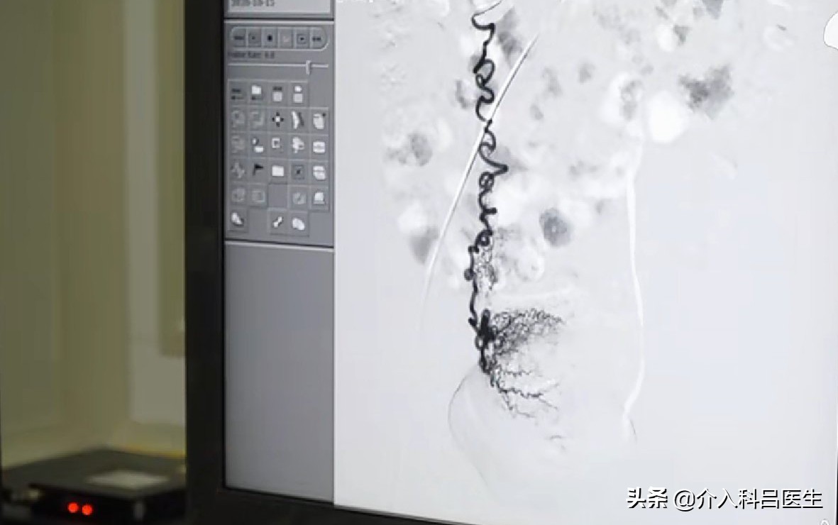 301医院前列腺增生介入治疗案例,介入栓塞治疗前列腺增生靠谱吗