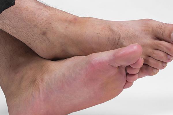 甲沟炎的嵌甲会随着指甲长出来吗,指甲根部嵌甲太深拔不出来怎么办