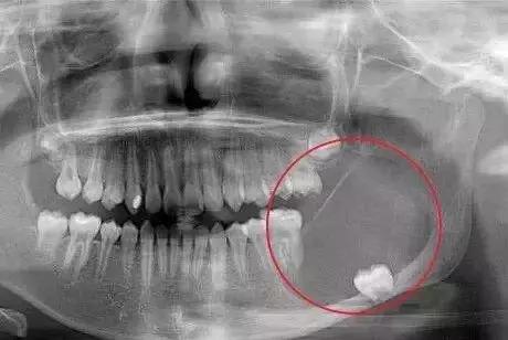 那些不拔智齿的人后来都怎么样了,那些该拔不拔的智齿最后都咋样了