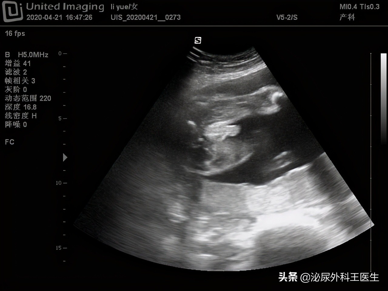 什么是阴式b超检查时有什么感觉,阴式b超检查前注意事项