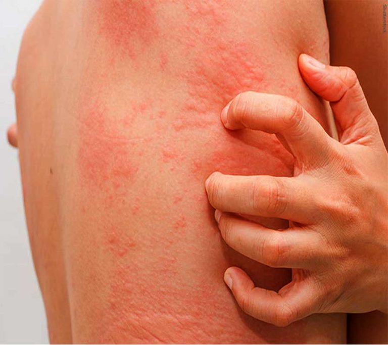 湿疹跟荨麻疹的区别有哪些,湿疹与荨麻疹的区别有哪些