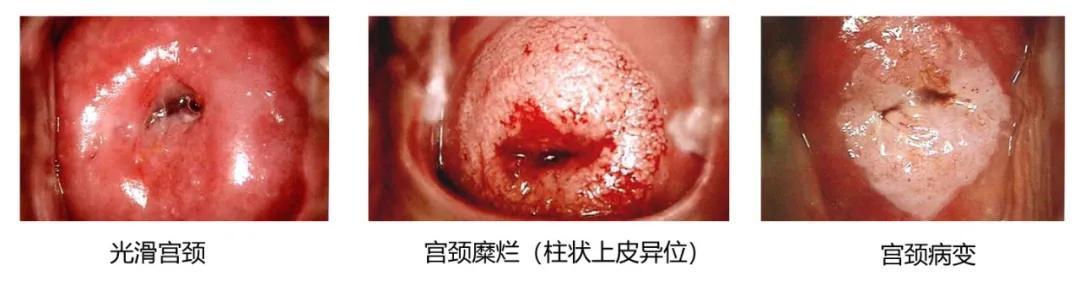 宫颈3度糜烂能治好吗,宫颈糜烂能治好吗要治多久