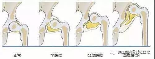 先天性髋关节脱位可以顺产吗,先天性髋关节脱位手术费多少