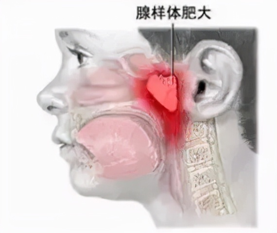 快速根治打鼾专利,打呼噜最新研究成果