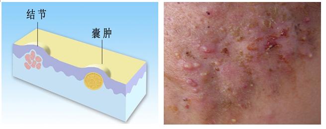 皮肤病蛇缠腰是什么症状,手部常见皮肤病的症状及治疗