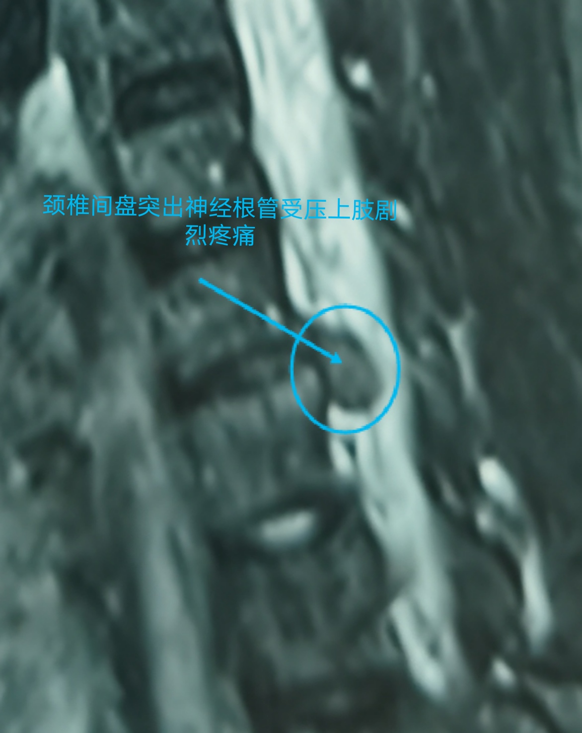 疫情期间颈椎病发作怎么办,疫情间躺久了头昏眼胀怎么治