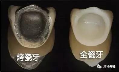 种植牙跟根管治疗可以同时进行吗,不要根管治疗可以么