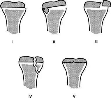 特殊骨折类型,特殊骨折体征