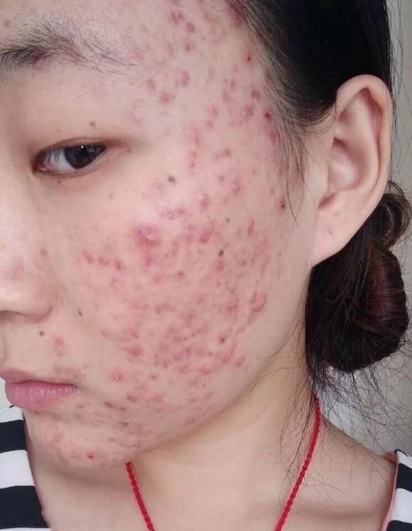 迅速解决青春痘的方法,青春痘怎么办最有效的方法