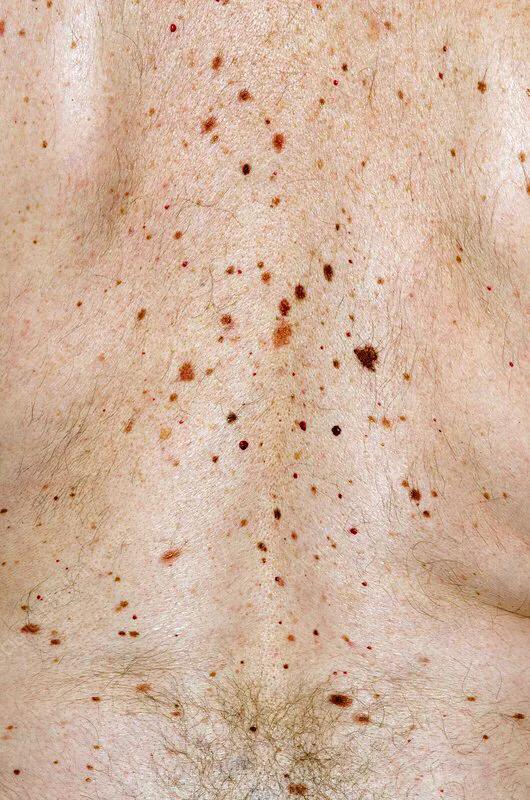 得了乙肝的人身上长红点怎么回事,乙肝病毒携带者身上有一颗颗红点