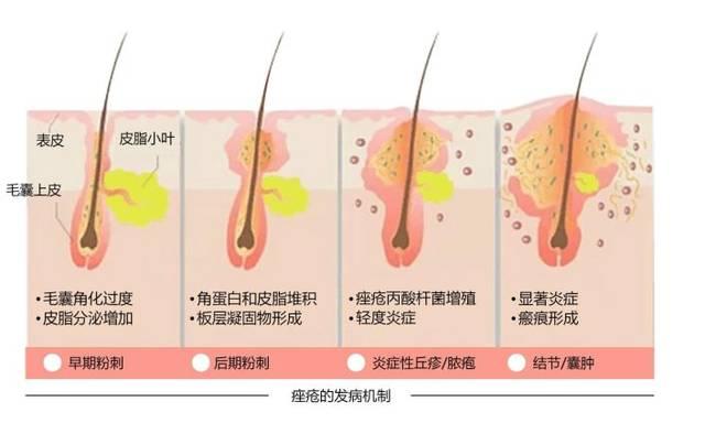 痤疮会自卑吗,痘疮病主要危害