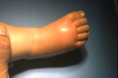 白破、百白破、百白破-Hib、百白破-Hib-IPV——疑问解答