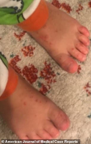 抗病毒治疗阿昔洛韦,抗病毒药膏阿昔洛韦