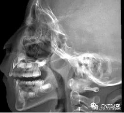 腺样体肥大有必要做x射线复查吗,最简单检测腺样体肥大的方法