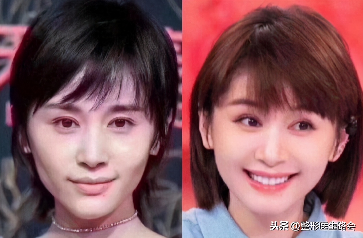 艺考生整容注意事项,艺考整形最佳方案