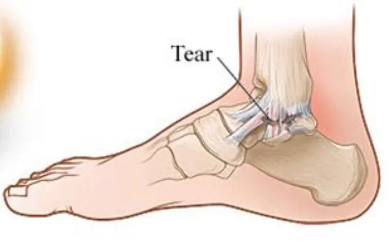 崴脚了要怎么自救,脚崴了一个月了该怎么办