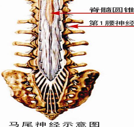 腰部马尾神经会影响大小便吗,腰痛伴坐骨神经痛