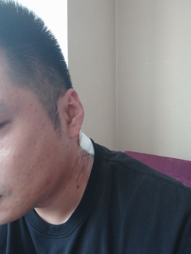 无麻痛不欲生,火疖子引流手术亲身经历