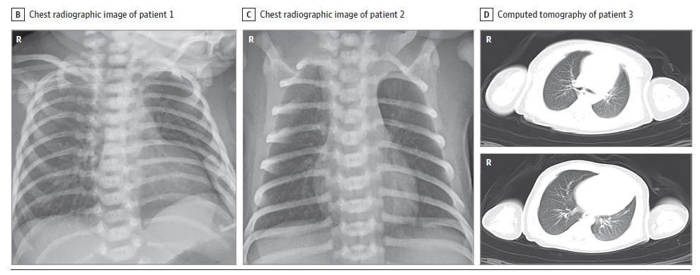 3个月新生儿感染新冠的几率,新生儿30天感染新冠