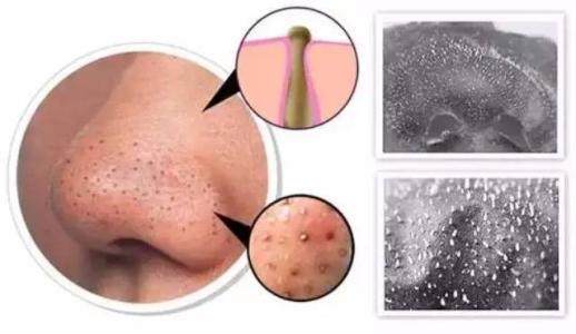 正确的去黑头方法是这样的,正确的去黑头方法