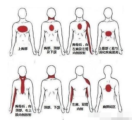 心绞痛发作该如何自救,心绞痛及时送医有救吗