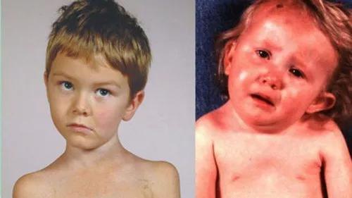 寰枢关节半脱位和落枕有什么区别,儿童落枕睡不了