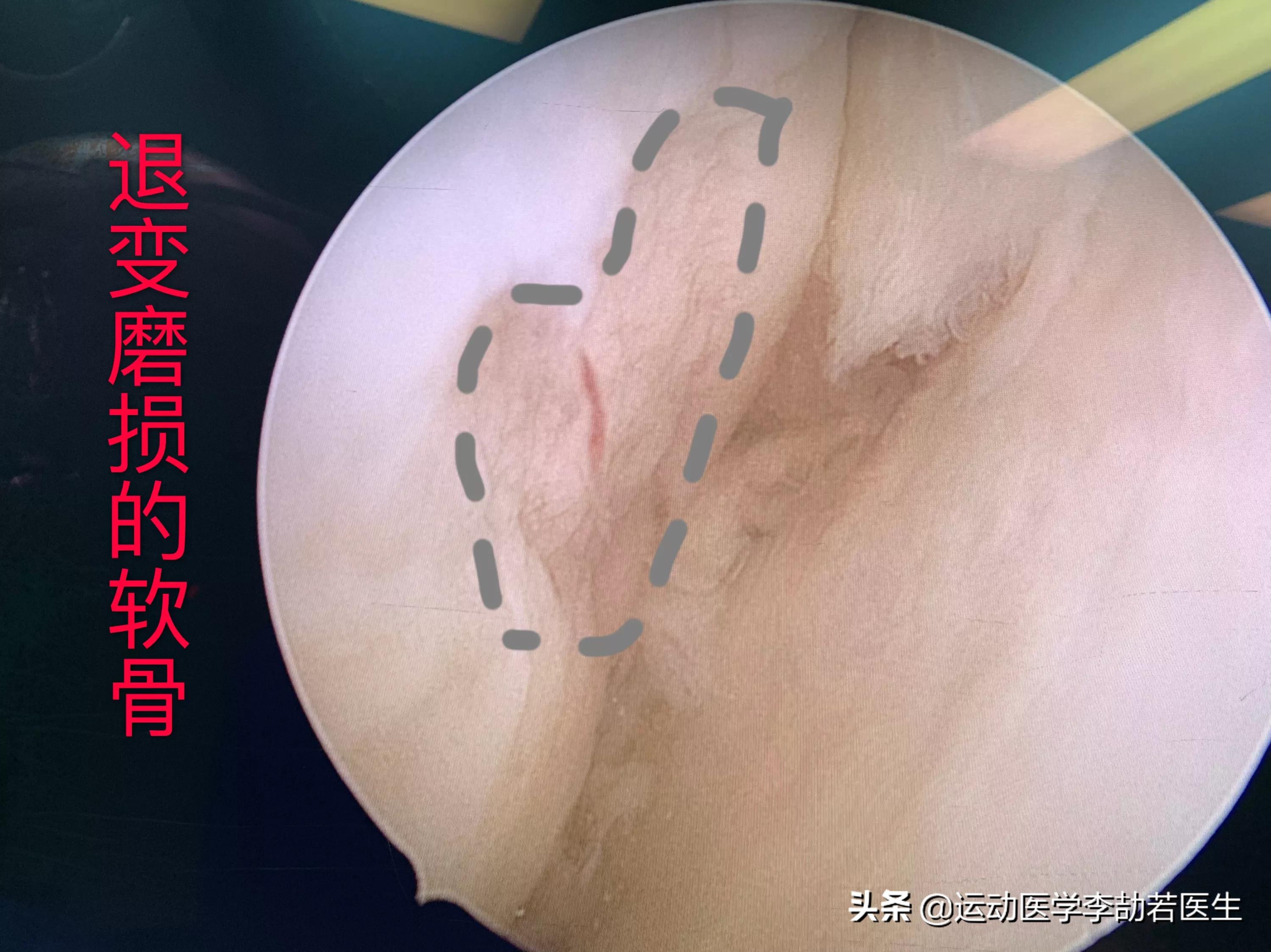 骨关节炎到底该怎么治,骨关节炎怎么治才能彻底治好