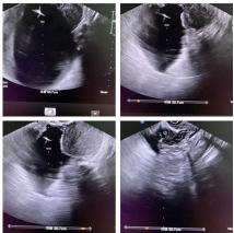 淄博妇幼保健院无痛要预约吗,淄博妇幼保健院无创plus