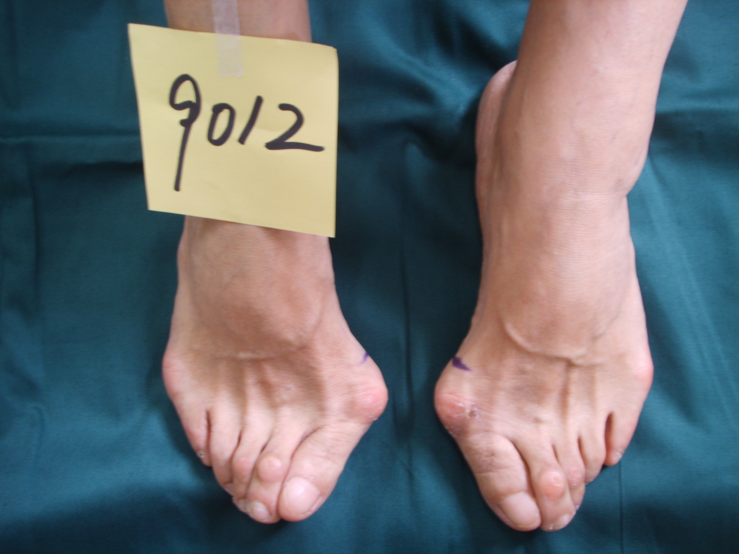 有大脚骨怎么办,让人尴尬的大脚骨该怎么解决