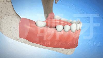 牙齿需要种植牙会经历几个步骤,种植牙流程什么情况需要做骨粉