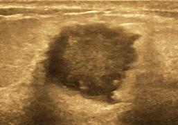 乳腺检查有疑似结节是什么意思,乳腺彩超报告中隐藏的秘密