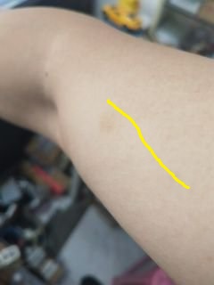 鱼刺卡喉的真实经历,鱼刺卡喉半年寻医无果