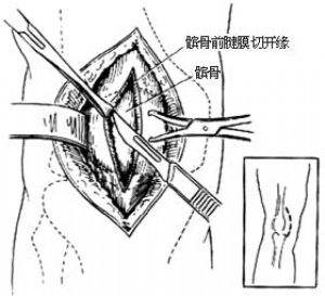 髌骨痛不能弯曲怎么办,髌骨不疼但脱位了怎么治