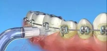 超详细的初戴正畸牙套的注意事项,戴全瓷牙套后需要注意什么