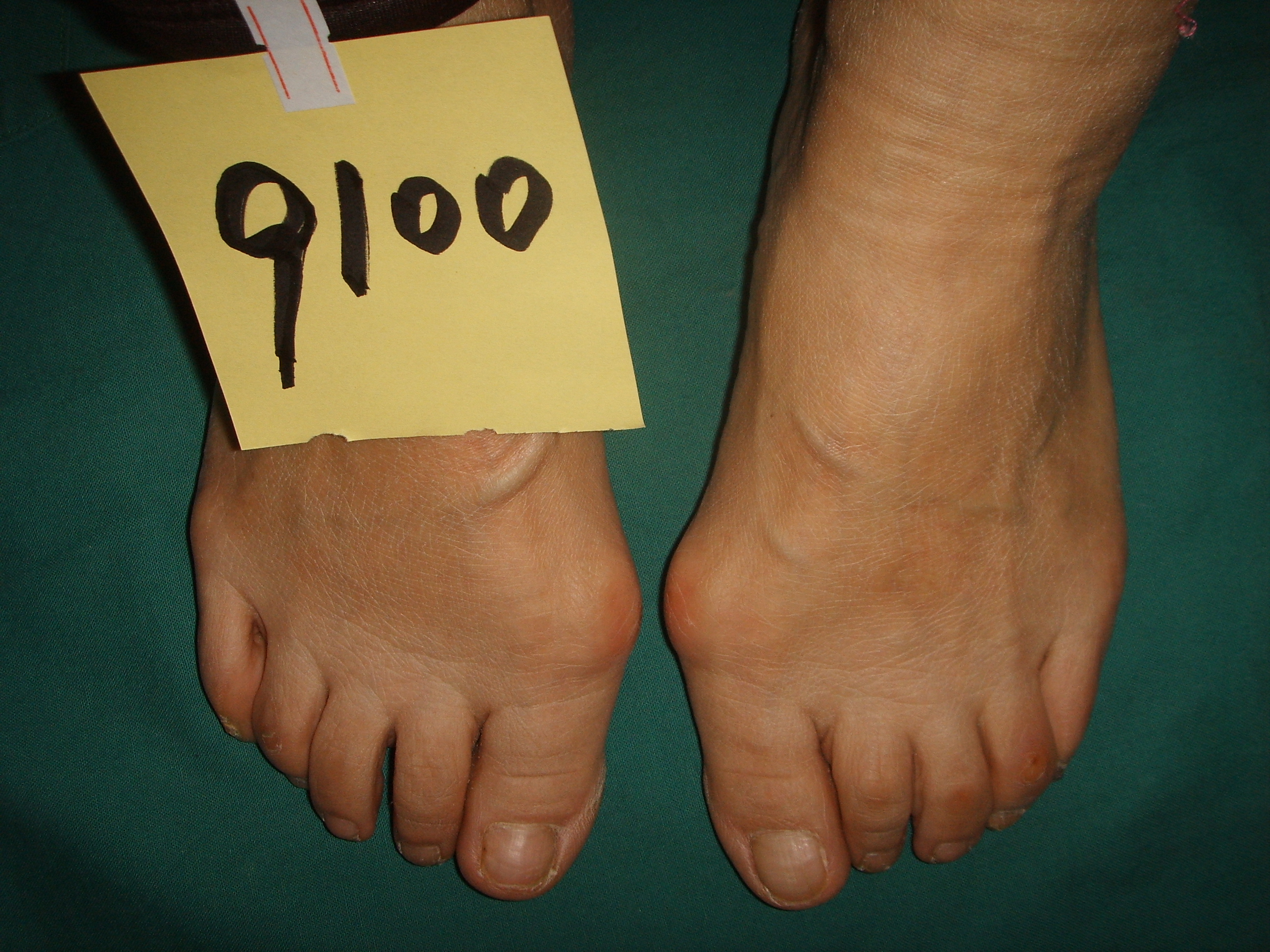 女性大脚骨图片大全,女士大脚骨