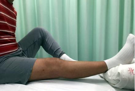 前叉术后不掰腿能不能恢复正常,前叉重建术后康复必须天天掰腿吗