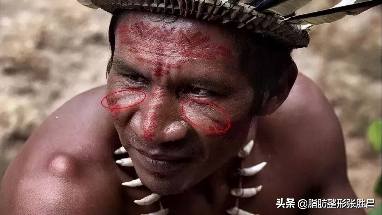 印第安皱纹,印第安纹去皱纹