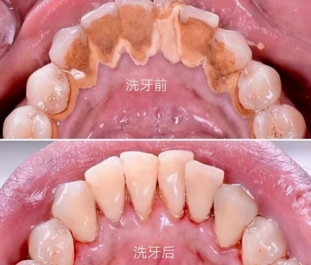 蛀牙与牙周炎哪个更严重,慢性牙周炎口腔健康的头号杀手