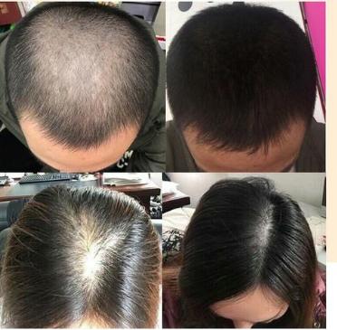 脱脂性脱发可以用康王洗发水吗 (康王生发防脱发吗)