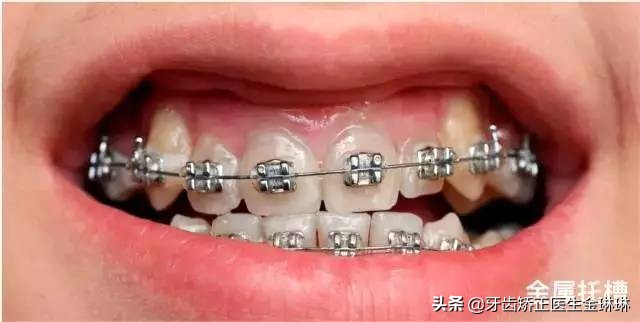 淄博矫正牙齿一般多少钱,淄博牙齿矫正一般多少钱