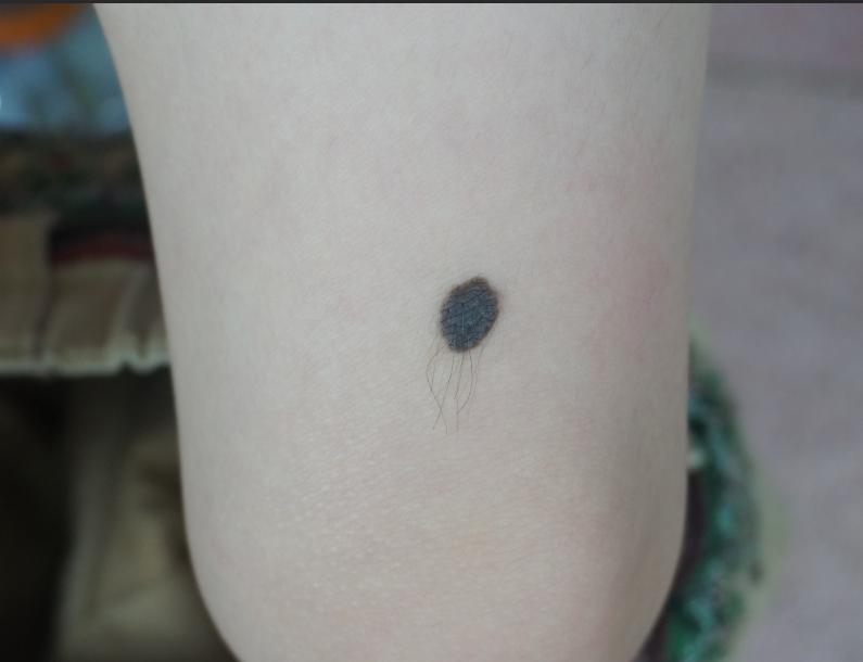 兽皮痣到底要不要切除,兽皮痣什么时候治疗合适