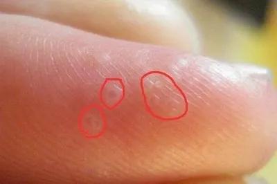夏天手指上起小水泡很痒怎么回事,为什么一到夏天手上就长水泡很痒