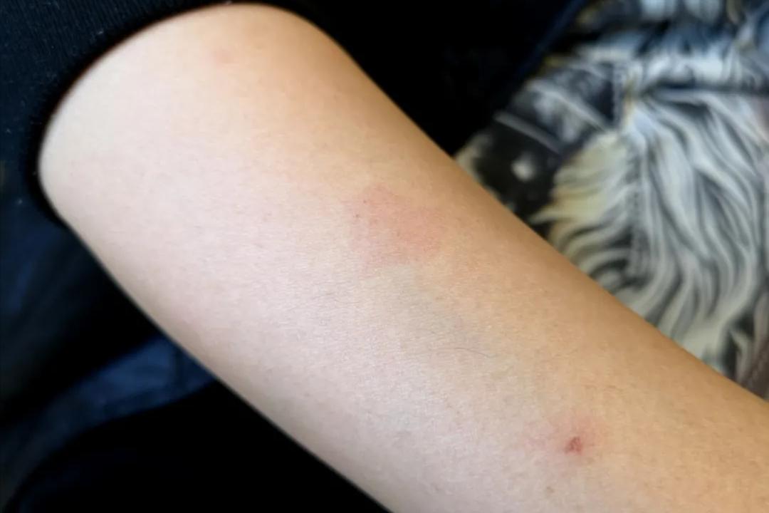 怀孕期间肚皮痒有红斑是怎么回事,孕晚期妊娠瘙痒性丘疹怎么治疗