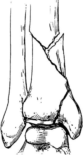 几种严重骨折医学名称,常见的骨折有哪些名称