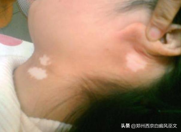 7岁儿童白癜风自愈案例,7岁儿童白癜风治愈经历