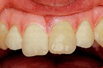 儿童牙外伤的分类及处理方法,儿童牙齿外伤需要检查哪些项目