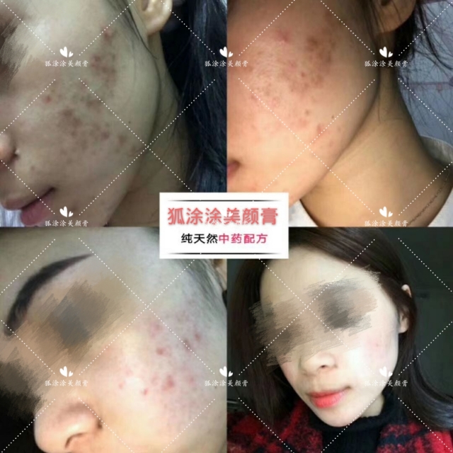 什么产品祛痘痘痘印效果好呢,祛痘印最好用的产品