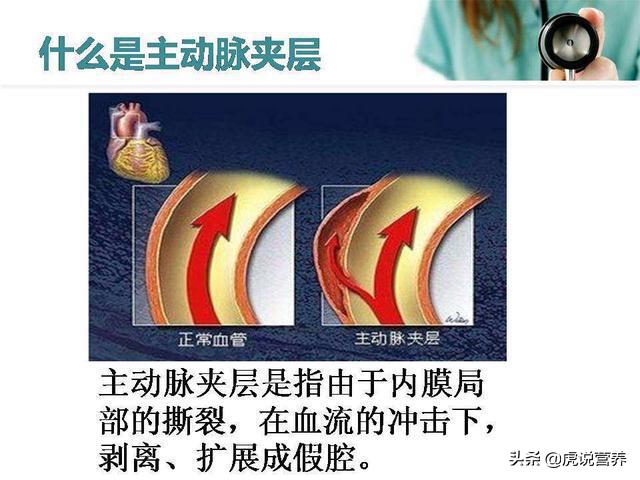 知名歌手得了可怕的心脏主动脉夹层,你了解吗